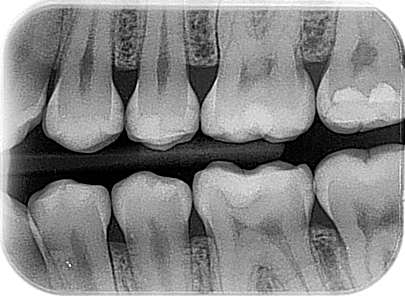 Radiografía Bitewing