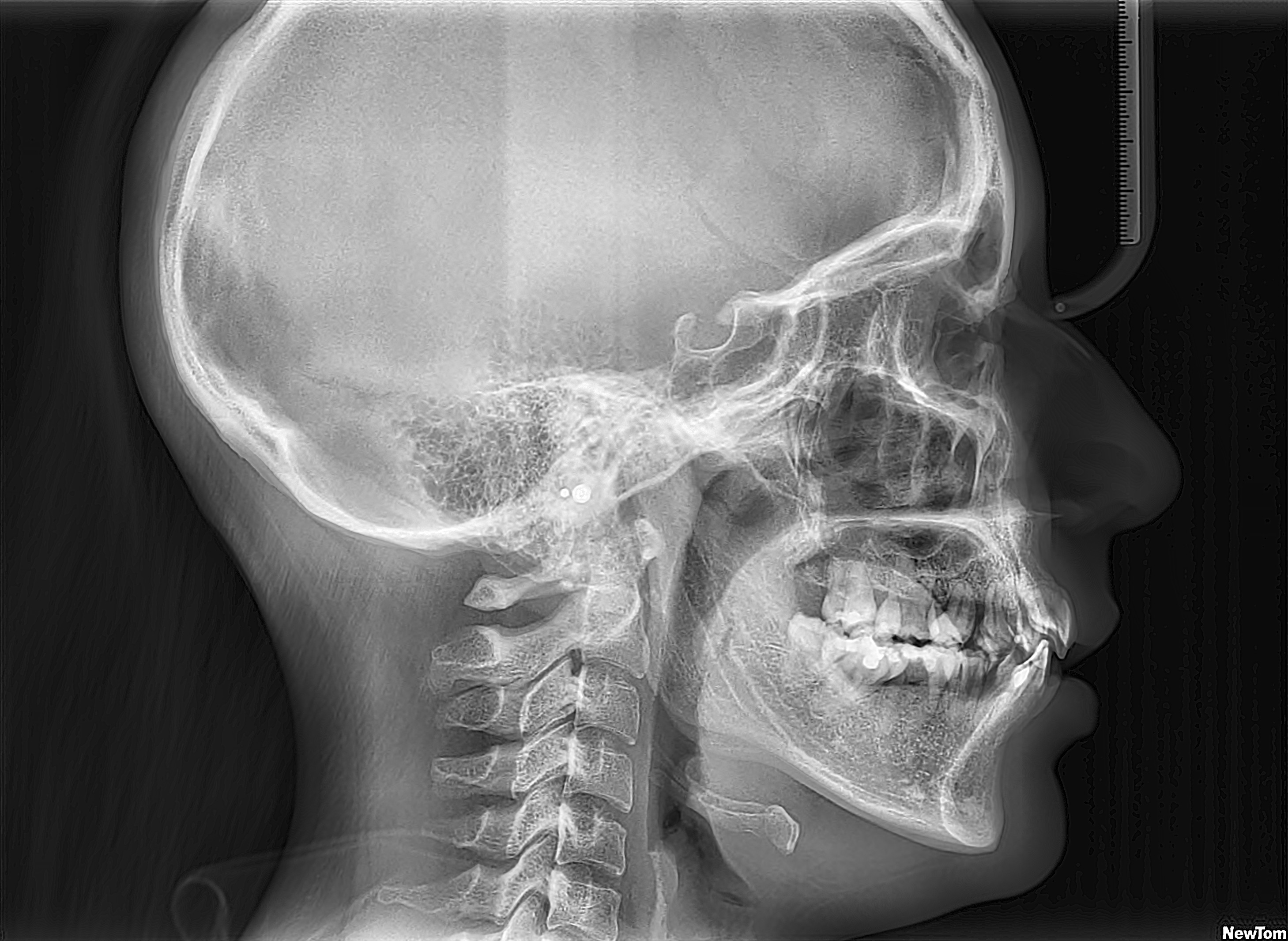 Telerradiografía Lateral