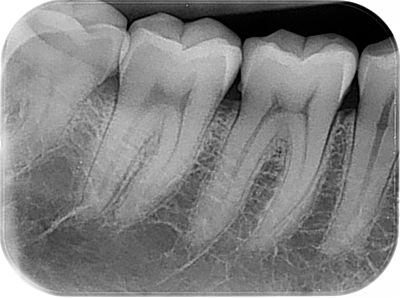 Radiografía Periapical
